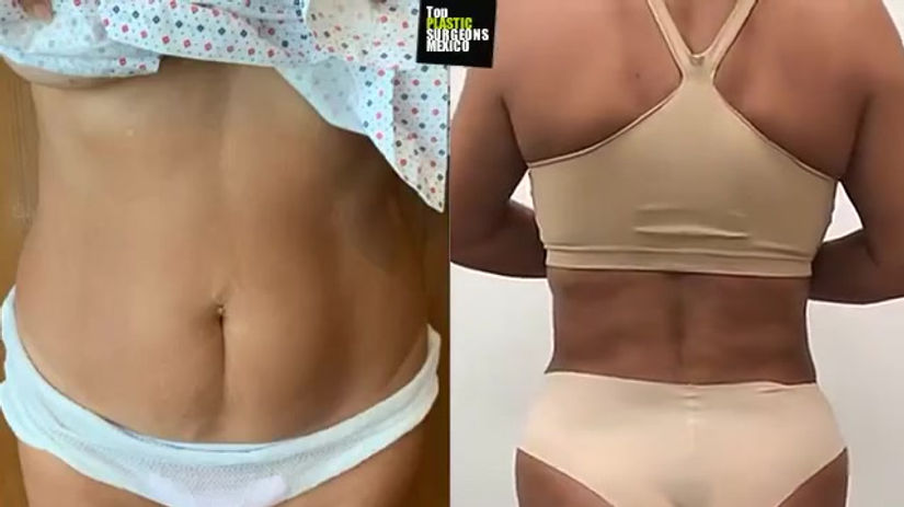 TUMMY TUCK + 360°LIPO